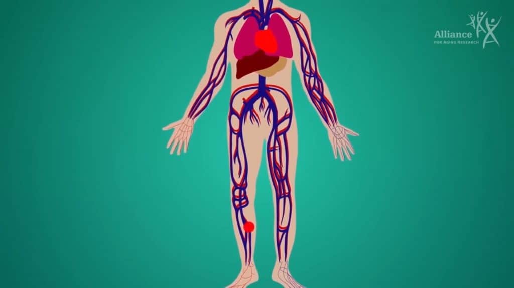 "Living with VTE and Preventing Deadly Blood Clots" video cover.