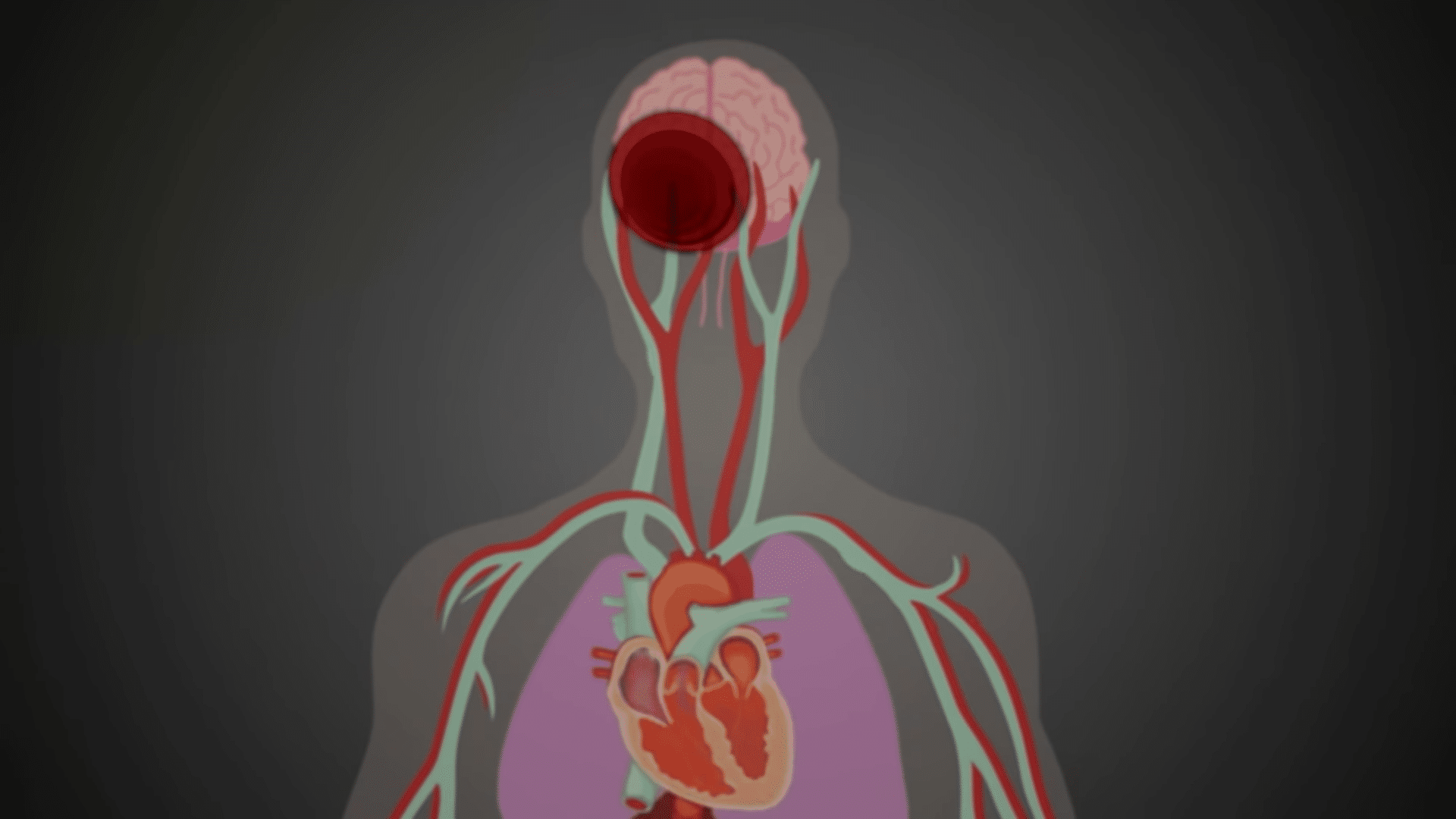 Anatomical drawing of stroke.