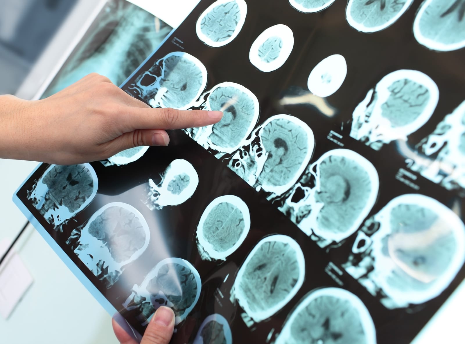 Person pointing at brain scan.