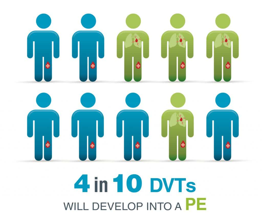 4 in 10 DVTs will develop into a PE