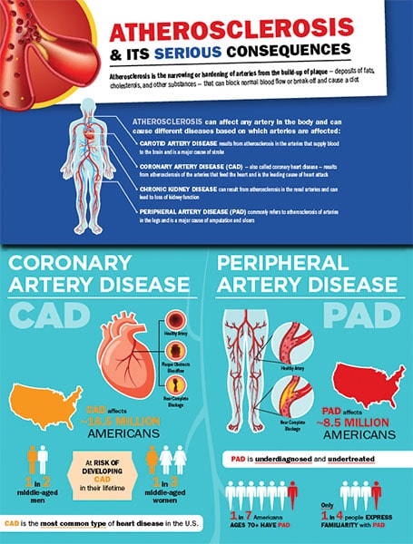 Infographic showing all the different areas of the body that are affected by Atherosclerosis.