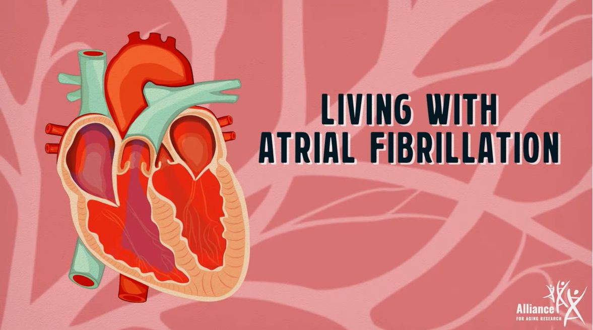 Illustration of a heart showing artial fibrillation.