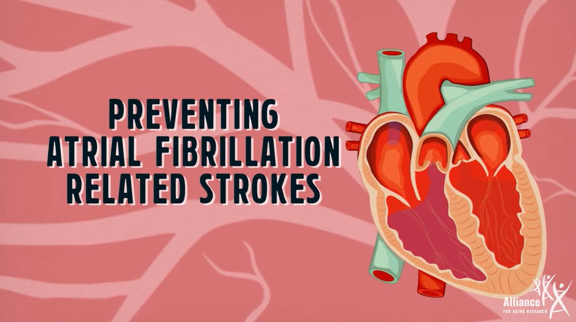 Illustration of a heart showing artial fibrillation.