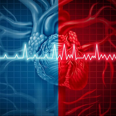 Illustration to show atrial fibrillation.