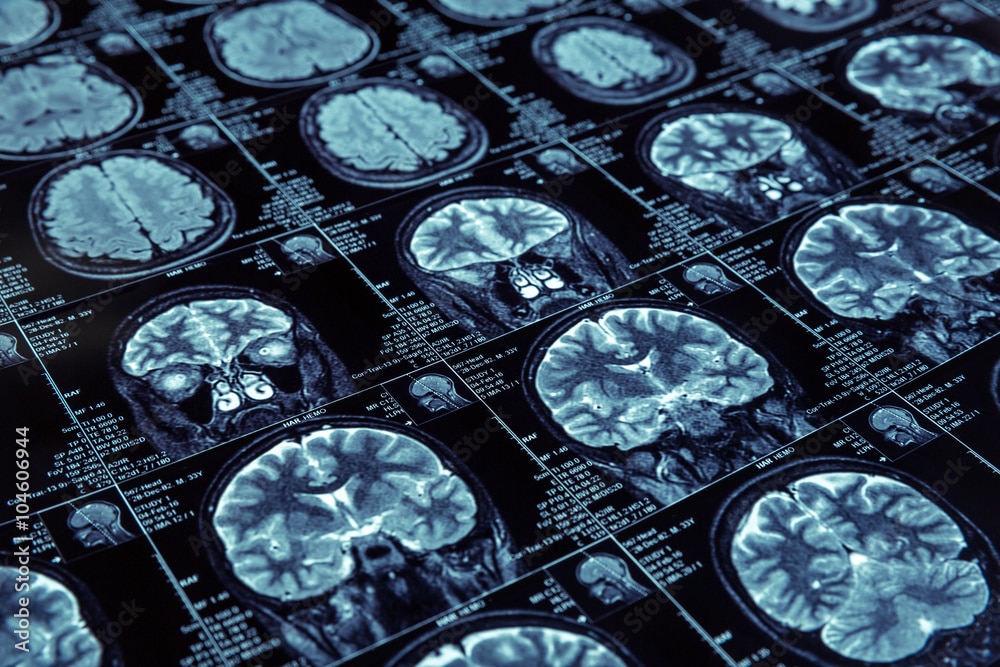 PET scan images of the brain on a lighted table.